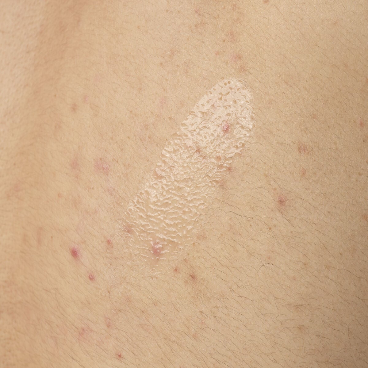 salicylic-acid-0-5-body-serum-i0 ORD-salicylic-acid-05-body-240ml-application.jpg