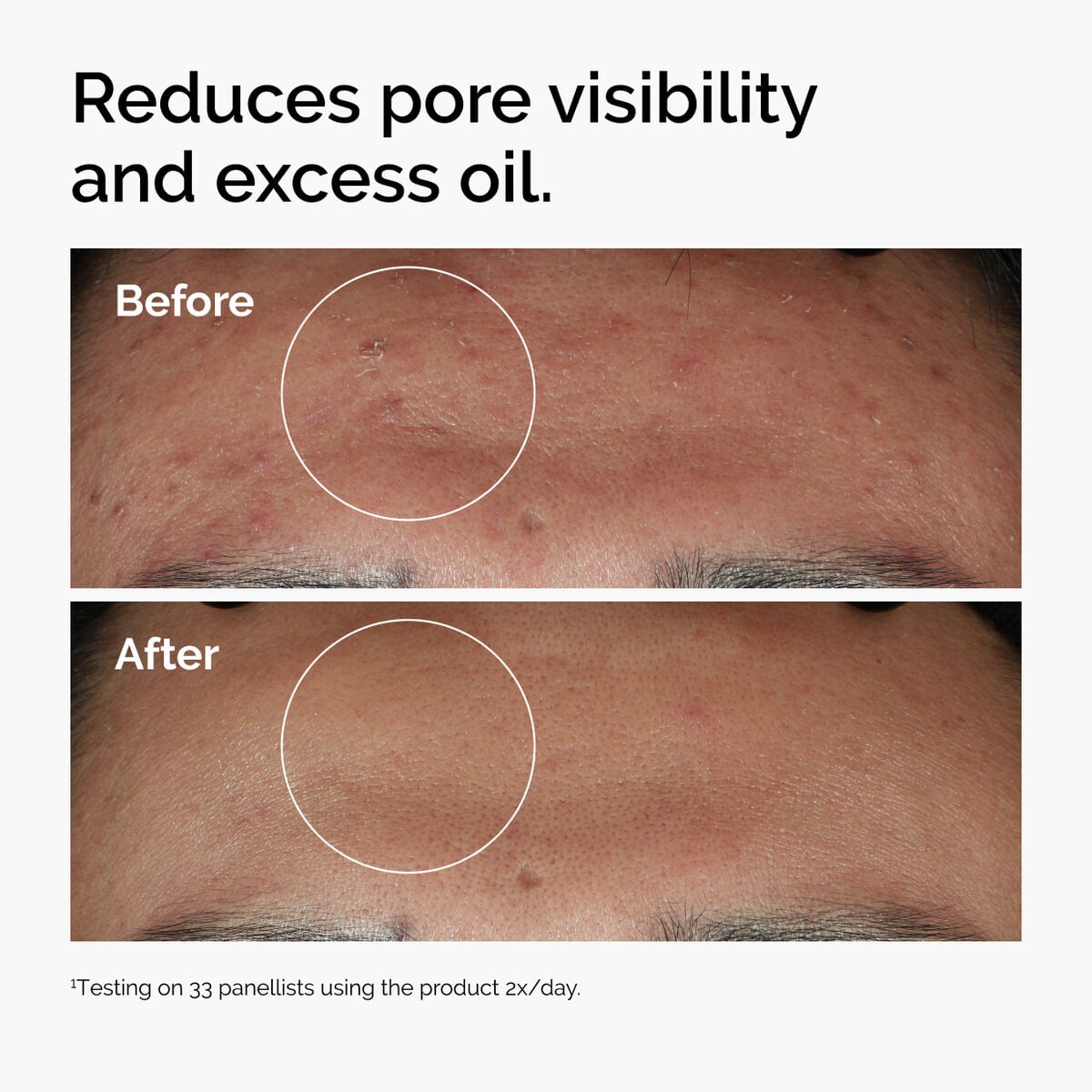 niacinamide-10-zinc-1-u8 ord-niacinamide-zinc-blemish-serum-before-after-pores.jpg