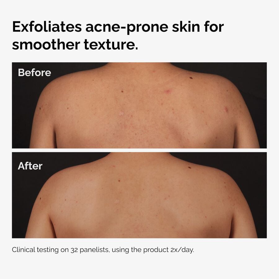 the-body-care-collection-x9 ord-salicylic-acid-body-serum-before-after-graphic-NA.jpg