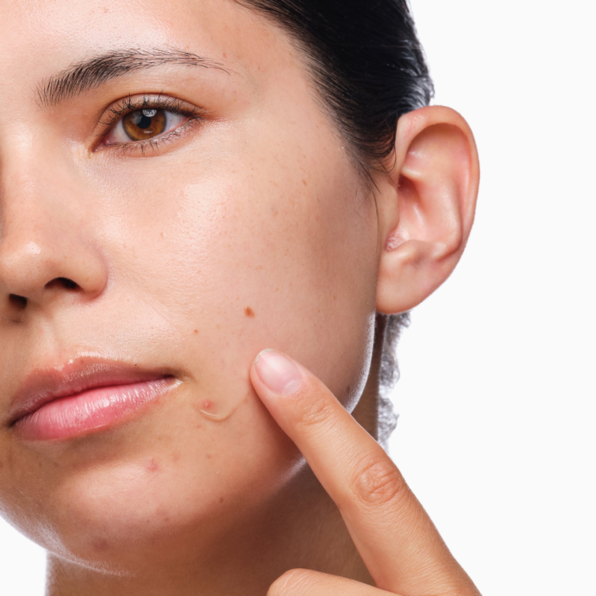 the-acne-set-a2 rdn-the-acne-set-application.png